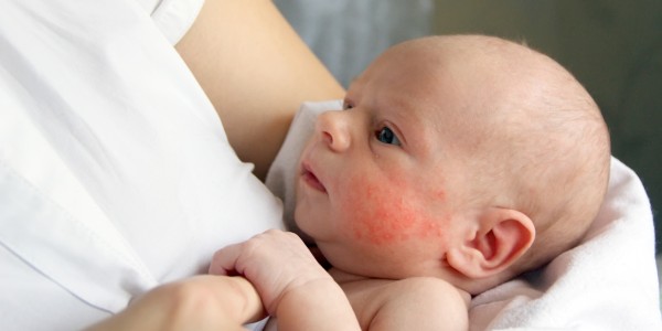 Wysypka u niemowlaka – dlaczego powstaje i jak ją leczyć?